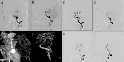 Endovascular Treatment of Large or Giant Non-saccular Vertebrobasilar Aneurysms: Pipeline Embolization Devices Versus Conventional Stents